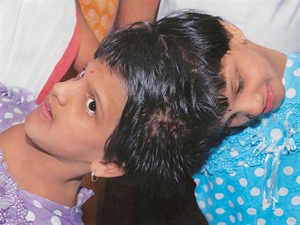  conjoined twins veena vani